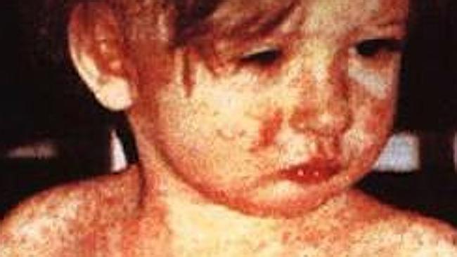 悉尼内西区恐爆发麻疹疫情